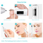 Xpreen XPRE061 Professional Dark Spot Remover Freckle Tattoo Chargeable Wart Mole Remover, with LED Screen and Spotlight – TPU