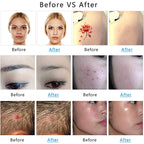 AA-A401 Small Freckle and Mole Removal Pen Tattoo and Eyebrow Removal Beauty Instrument, Red Light Plug-in, Blu-ray Plug-in, Red Light Battery, Blu-ray Battery